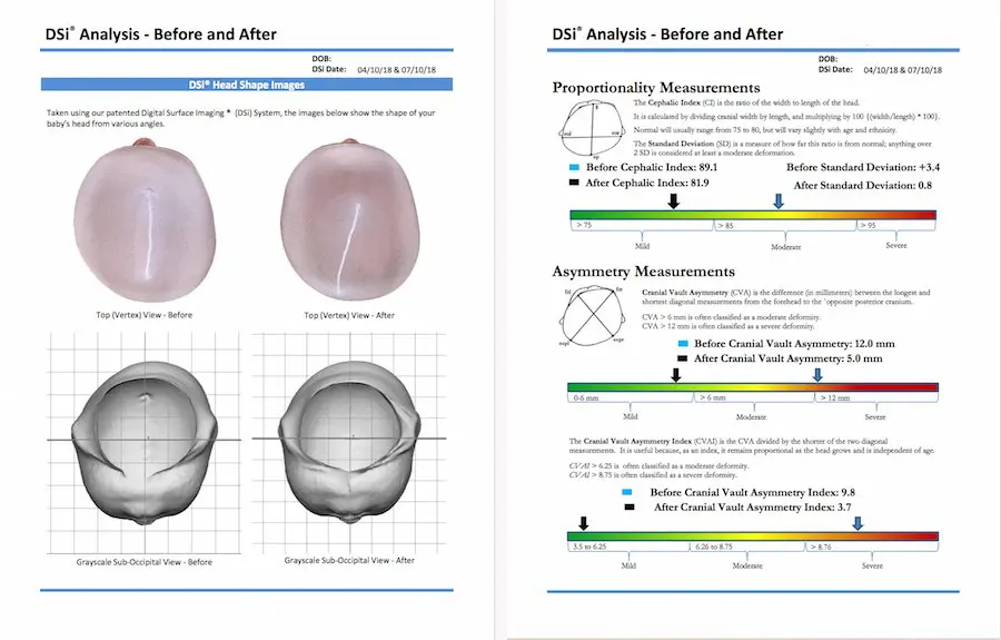 Plagiocephaly and Helmet Journey, Cranial Tech, Cranial Technologies, DOC Band Helmet, Hanger Clinic, STAR Band, Cranial Helmet, Torticollis, How to Clean a Cranial Helmet, How to Decorate a Cranial Helmet, How Long is a Cranial Helmet Worn?, What is Plagiocephaly?, What Causes Plagiocephaly?, Doc Band Review